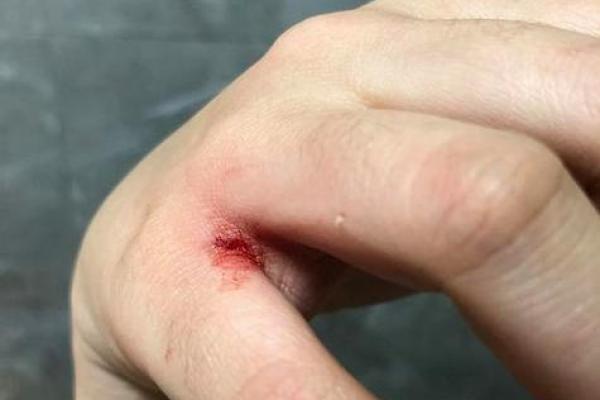 做梦梦到被猫咬了寓意是什么